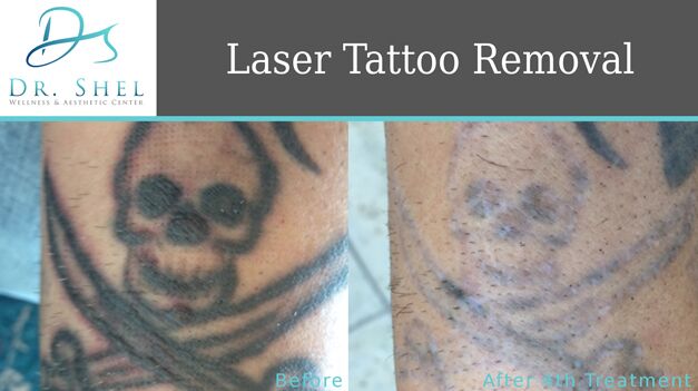 does glutathione affect tattoos Zuwa Glutaglow Glutathione Capsules help promote brighter,  healthier-looking skin while supporting antioxidant protection from within main image 1