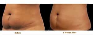 lipo c injections katy Lipo-C for Energy & Metabolism in Bourbonnais, IL Coolsculpting Fat Removal Katy City