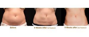 Coolsculpting Fat Removal Katy City TX